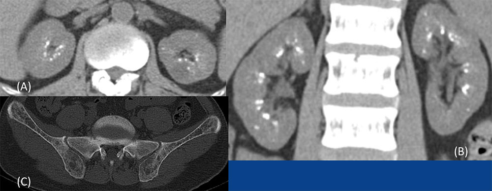 Medullary Nephrocalcinosis
